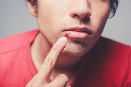 cold sores, stages of cold sores